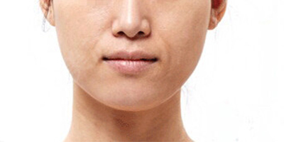 注射去法令紋術(shù)前