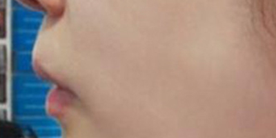 水光娃娃術(shù)后