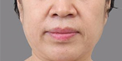 PRP美塑美膚術前