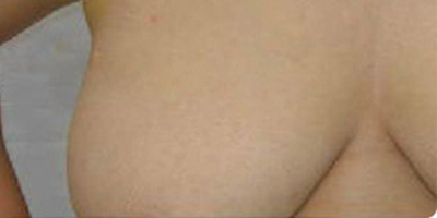 吸脂去副乳術(shù)后