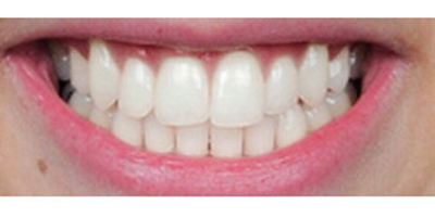 超聲波洗牙術(shù)后