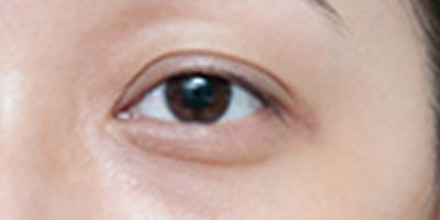 自體脂肪豐眼窩術(shù)前