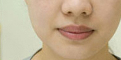 厚唇改薄術(shù)后