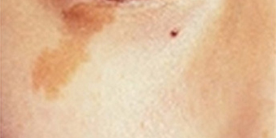 皮秒激光術(shù)前