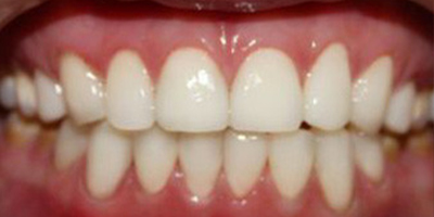 樹脂貼面術(shù)后