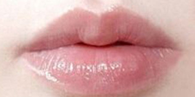 自體脂肪豐唇術(shù)后