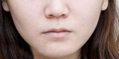 嘴角上揚(yáng)術(shù)術(shù)前