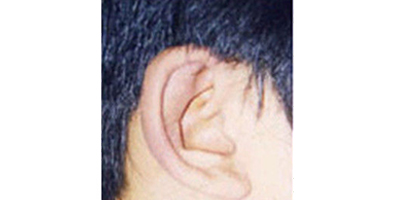 杯狀耳矯正術后