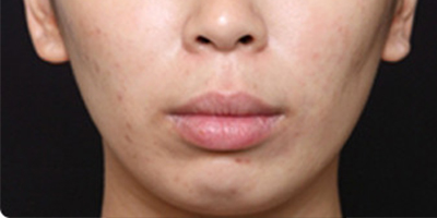 注射頦肌放松術前