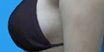 自體脂肪隆胸術(shù)后