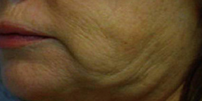 熱拉提術(shù)前