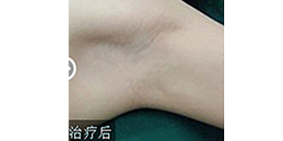 注射去狐臭術(shù)后