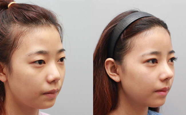 耳軟骨隆鼻的優(yōu)缺點是什么？肋軟骨隆鼻和耳軟骨隆鼻有什么區(qū)別？