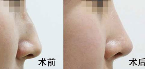 駝峰鼻矯正的方法有哪些？駝峰鼻矯正的方式及適合人群？