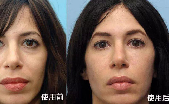 法令紋去除手術(shù)效果好嗎？法令紋怎么消除?最好的方法是什么？