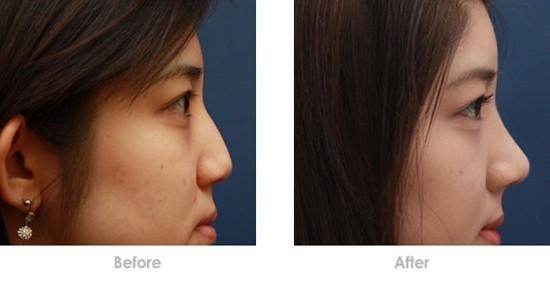 隆鼻假體取出后鼻子會(huì)不會(huì)變形？隆鼻假體取出后能不能恢復(fù)原樣？