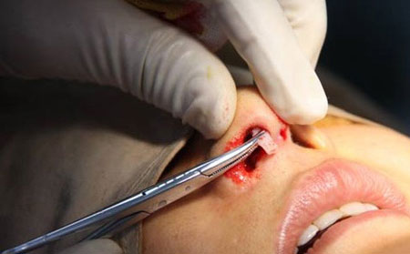 鼻子假體取出需要多少錢？取出后鼻子會恢復(fù)原來樣子嗎？