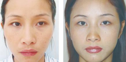 假體填充豐太陽穴怎么做？假體豐太陽穴的方法有哪些？