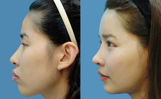 上下顎矯正術(shù)是什么手術(shù)啊？下頜角骨骼大用什么方法去除？