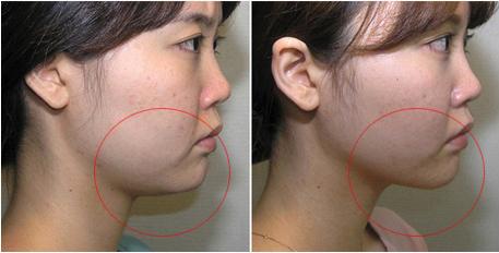 雙下巴吸脂多長(zhǎng)時(shí)間恢復(fù)？雙下巴吸脂術(shù)能保持多久？