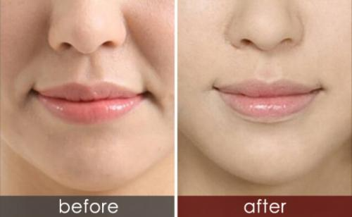 玻尿酸祛除法令紋的優(yōu)勢(shì)？玻尿酸和肉毒素祛法令紋，哪一種效果好？