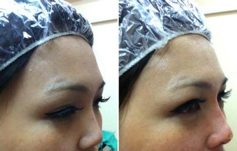 埋線手術(shù)鼻子的效果能保持多久?埋線手術(shù)隆鼻術(shù)后注意事項(xiàng)是什么?