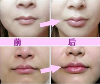 玻尿酸豐唇珠效果怎么樣？玻尿酸豐唇珠多少錢？