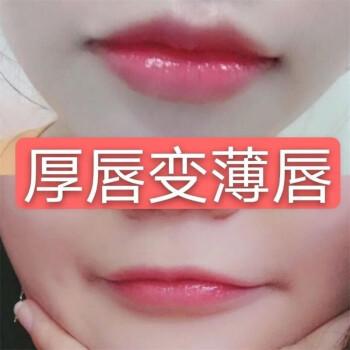 厚唇改薄整形手術(shù)價格？厚唇改薄多久完全恢復(fù)？