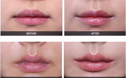 嘴角上揚術有幾種方法？嘴角上揚術疤痕恢復期？