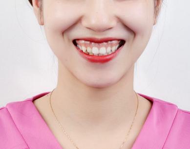 露齦笑能矯正嗎？肉毒素治療露齦笑注射量是多少？