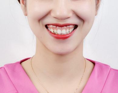 露齦笑能矯正嗎？肉毒素治療露齦笑注射量是多少？