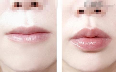 唇部綜合整形手術(shù)項(xiàng)目有哪些？唇部綜合整形多少錢？