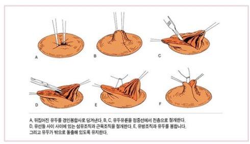 乳頭內(nèi)陷矯正手術(shù)多少錢？乳頭內(nèi)陷矯正手術(shù)多久可以恢復(fù)？