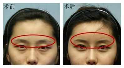 自體脂肪填充眉弓安全嗎？自體脂肪填充是永久的嗎？