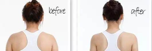 后背抽脂那些人可以做？吸脂瘦肩膀多少錢？