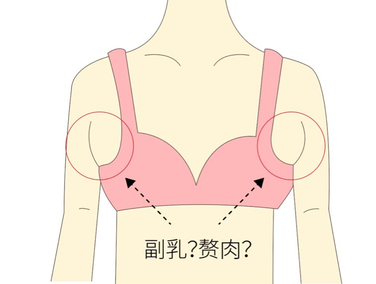 手術(shù)去副乳效果怎么樣？手術(shù)去副乳要注意什么？