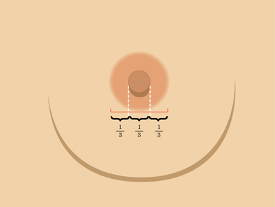 乳暈縮小如何矯正 乳暈縮小術(shù)的注意事項有哪些？