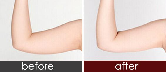 手臂抽脂效果明顯嗎 ？吸脂瘦手臂會反彈嗎？