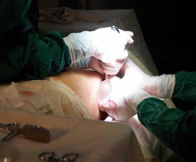 胸部假體取出多久可以重新做 ？胸部假體取出注意事項？