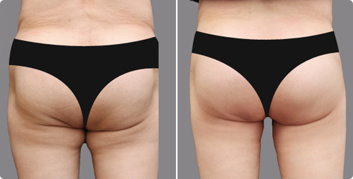 吸脂瘦臀部?jī)r(jià)格多少？吸脂瘦臀術(shù)后如何護(hù)理？