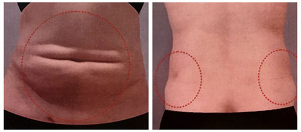 吸脂失敗了多久可以修復(fù)？吸脂失敗修復(fù)怎么解決？