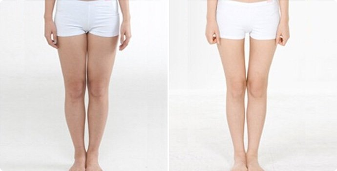 冷凍溶脂瘦大腿如何護理 冷凍溶脂瘦大腿為什么反彈