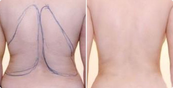 射頻溶脂瘦后背術(shù)多少錢 射頻溶脂瘦后背術(shù)后需要注意什么