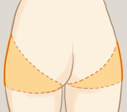  射頻溶脂瘦臀部的優(yōu)缺點(diǎn) 射頻溶脂有哪些功效