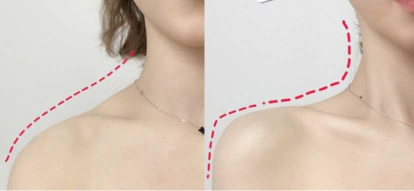 隔空溶脂瘦肩部注意事項 隔空溶脂瘦肩部如何術(shù)后護理