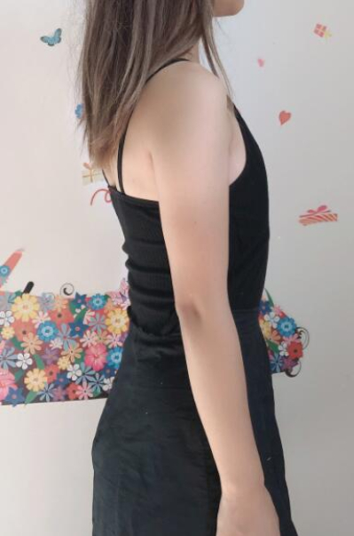 上海德琳醫(yī)療美容醫(yī)院金成德假體隆胸案例效果分享