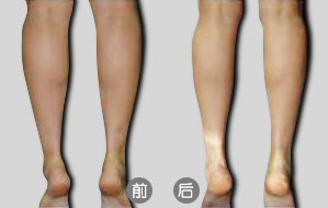 隔空溶脂瘦小腿后如何術(shù)后護(hù)理  隔空溶脂瘦小腿多少錢