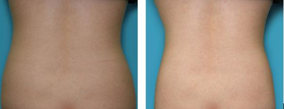 隔空溶脂瘦腰多少天見(jiàn)效 隔空溶脂瘦腰有什么副作用