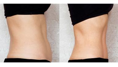 超聲溶脂瘦腹部有什么副作用 超聲波溶脂多少錢(qián)一次