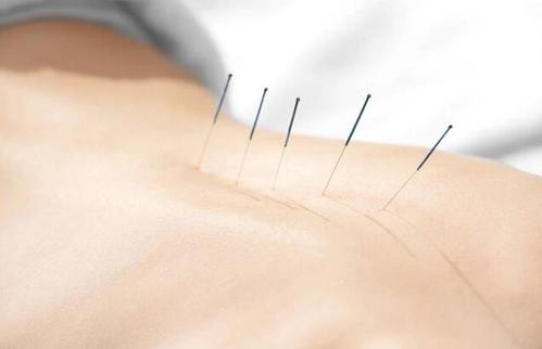 埋線減肥多少錢一次？埋線減肥多久才能有效果